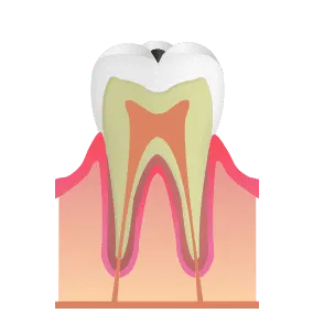 エナメル質まで進行した虫歯