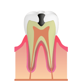 象牙質まで進行した虫歯