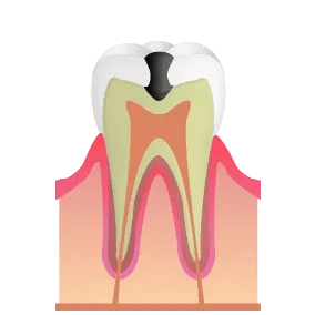 象牙質まで進行した虫歯