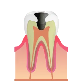 神経に達した虫歯