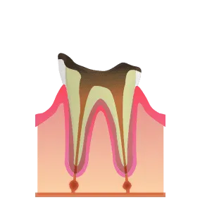 歯根のみ残っている虫歯