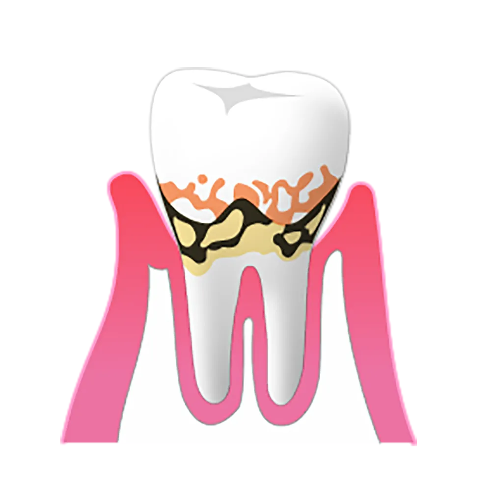 初期歯周炎
