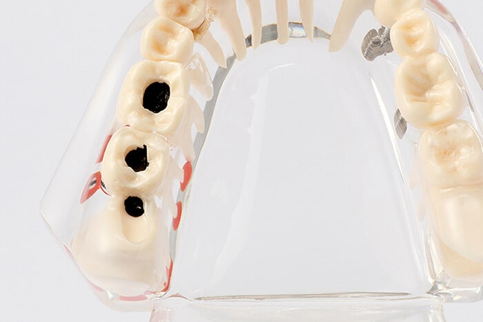 虫歯の治療方法・進行度
